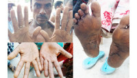 আর্সেনিক আক্রান্ত বালিয়াডাঙ্গা ইউনিয়নের বেতবাড়িয়া গ্রামের  অধিকাংশ মানুষ
