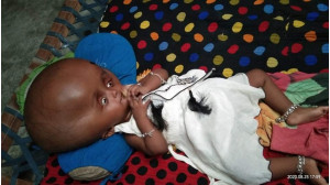 চাঁপাইনবাবগঞ্জে বিরল রোগে আক্রান্ত ছোট্ট শিশু তাশমিমা : প্রধানমন্ত্রীর সাহায্য কামনা